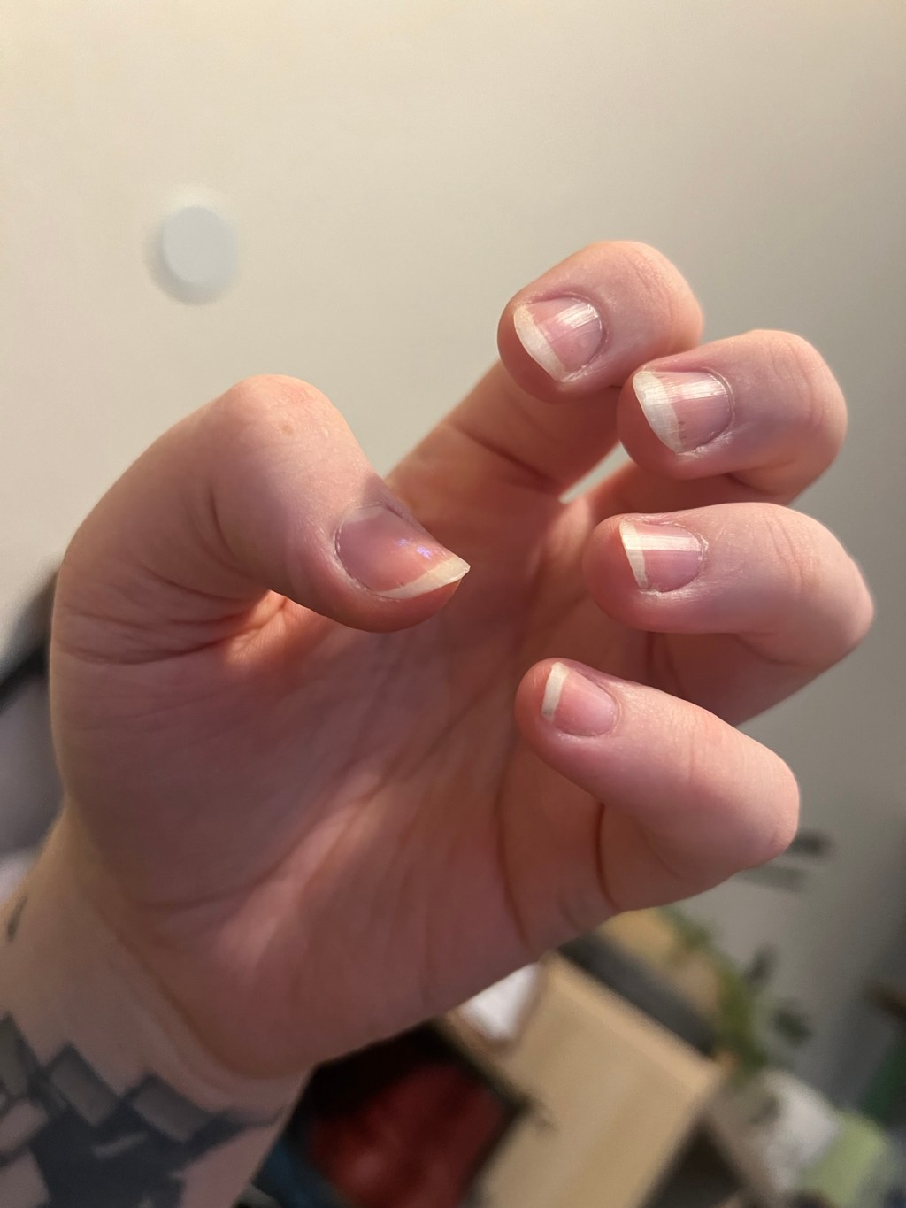 a light at the end of the tunnel – psoriasis journey&nbsp;#5